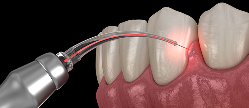 Tooth & Gum Contouring At Smiles By Design in Kernersville, NC