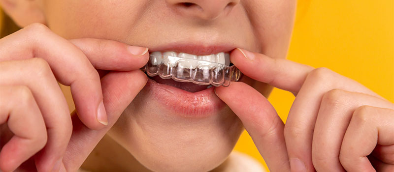 Invisalign Go & Braces At Smiles By Design in Kernersville, NC